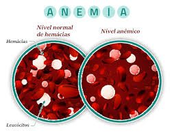 Anemia